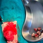 bladder stone removed by surgery